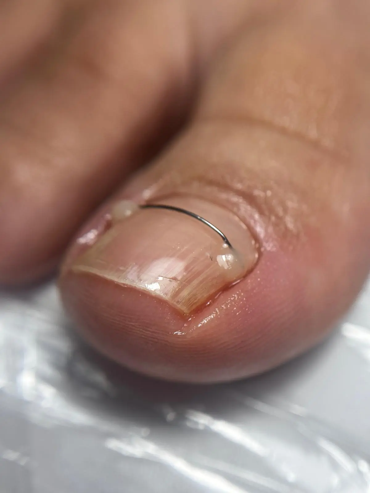 pedichiura problematica pedichiura problematica